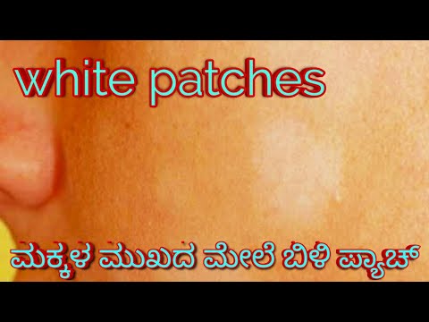 White patches, children skin disease,food style