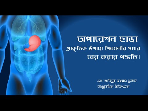 বিনা অপারেশনে পিত্তথলীর পাথর বের করুন