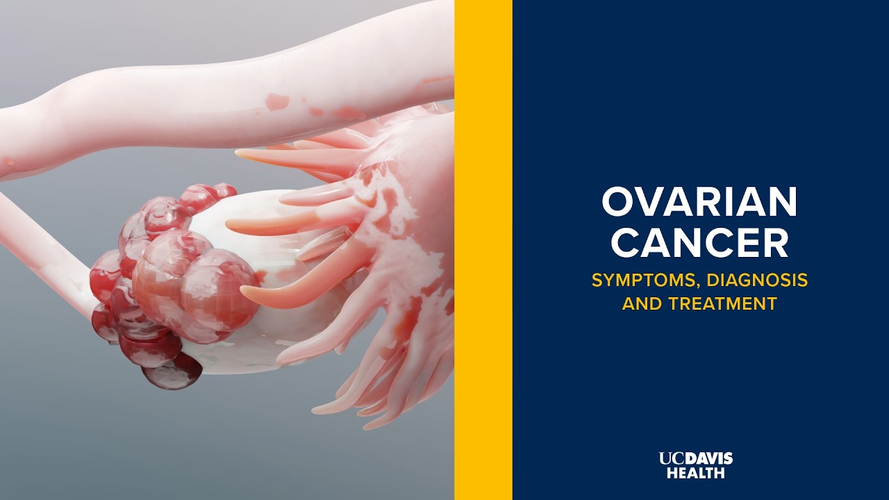 Thumbnail preview of Ovarian Cancer: Symptoms, Diagnosis and Treatment