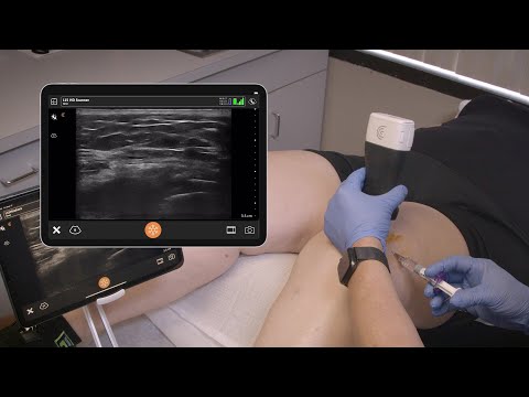 Suprapatellar Injection of the Knee - Ultrasound Scanning Technique