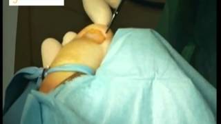 Cirugía de onicocriptosis (Uña encarnada). Ingrown toenail surgery. Winograd modificado - Clínica Podológica Málaga Centro
