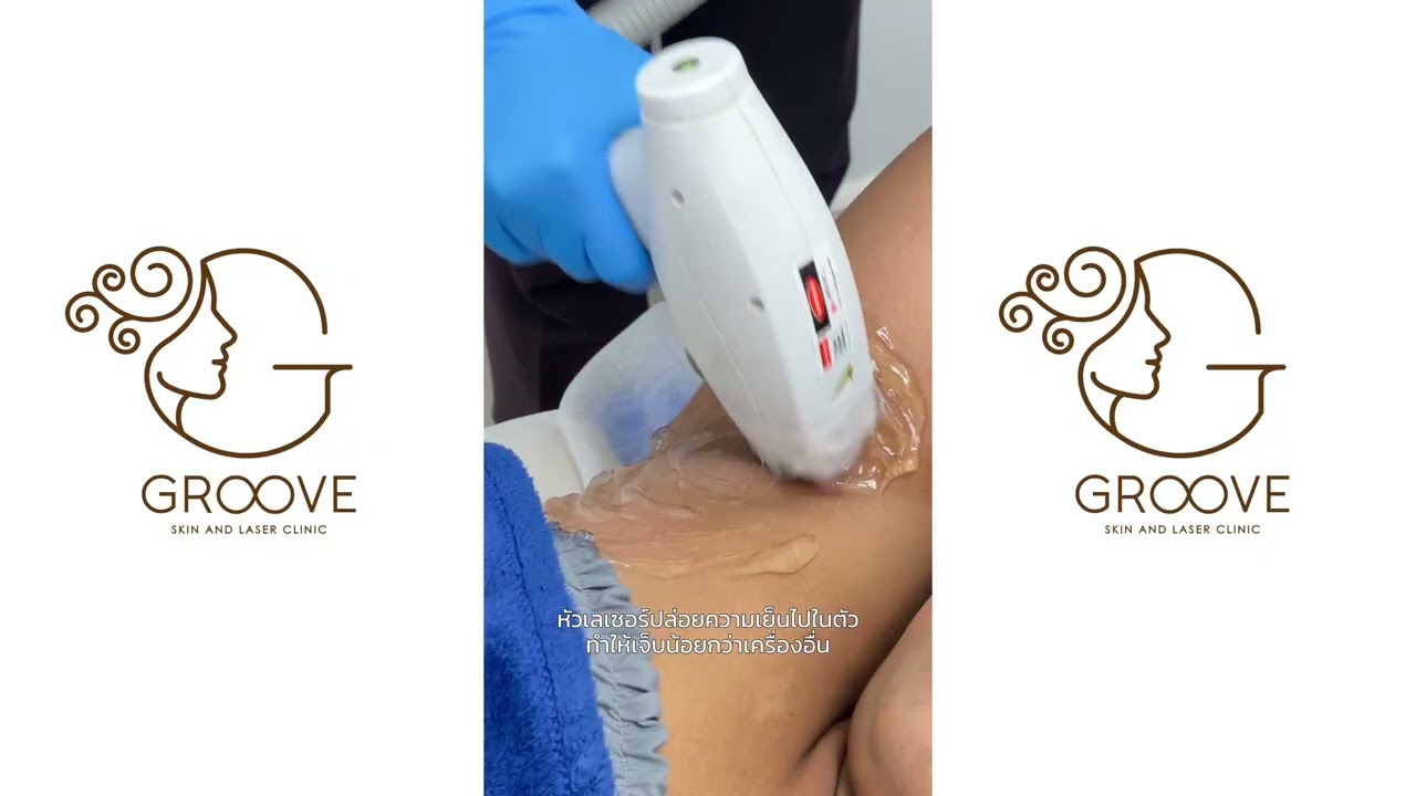 รีวิวกำจัดขนถาวร