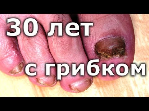 ВЫЛЕЧИЛ грибок ногтей спустя 30 лет / Лечение грибка ногтей на ногах