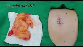 소아 지방종 환자의  수술영상입니다.
