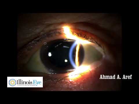 Eye Examination of a Cataract