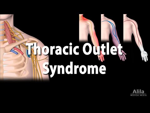 Thoracic Outlet Syndrome (TOS), Animation
