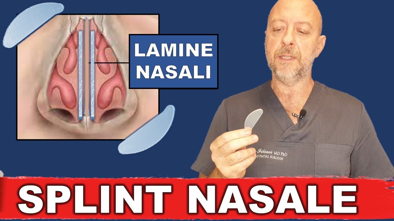 Watch Now Cos'è uno splint nasale A cosa serve la lamina nella settoplastica Ma fa male rimuoverla Cos'è uno splint nasale A cosa serve la lamina nella settoplastica Ma fa male rimuoverla