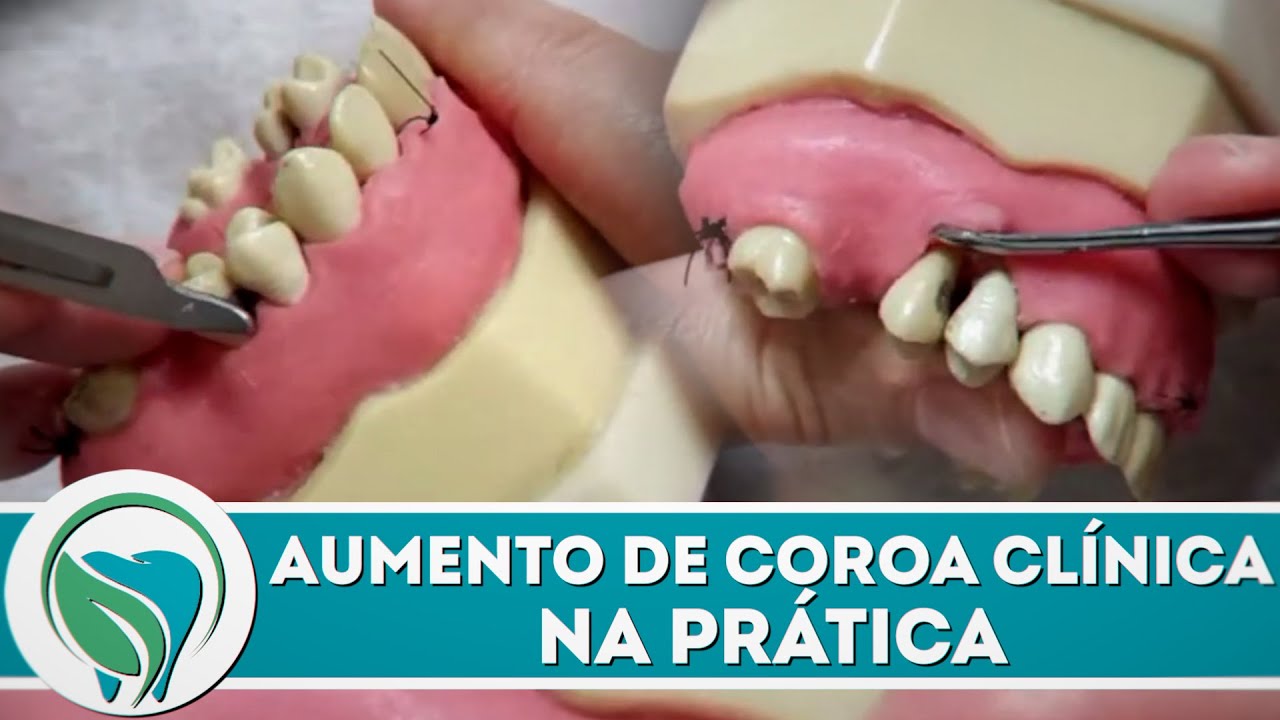 Aumento de Coroa Clínica na PRÁTICA!