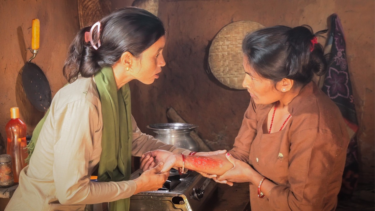 Home Care of Burns (Kyrgyz) - Emergency Care Series