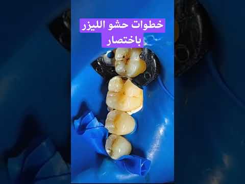 حشو الأسنان ببساطة