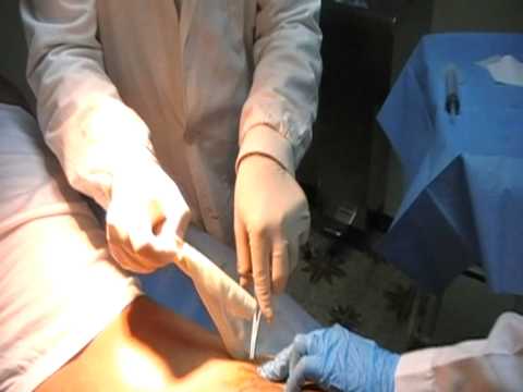 Parassiti in unepilessia cerebrale Come eliminare vermi da un organismo