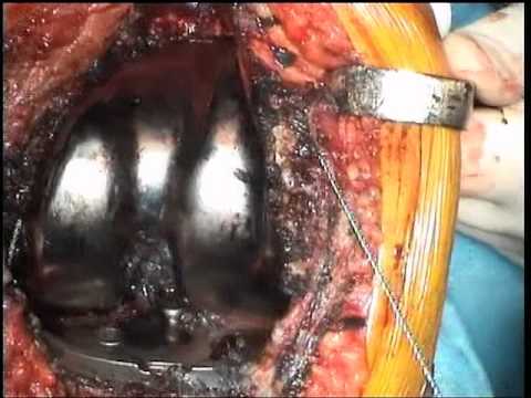Massaggio terapia per la malattia degenerativa del disco cervicale Danneggiamento della spalla labbra fibrose come guarire