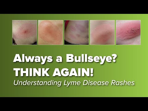 Think the Lyme Disease Rash is Always a Bull's-eye? Think Again!  | Johns Hopkins Rheumatology