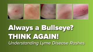 Think the Lyme Disease Rash is Always a Bull