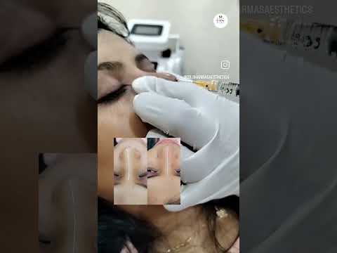 Liquid Rhinoplasty