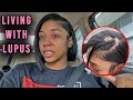 Living with Lupus: Finding out I have Lupus instead of Alopecia