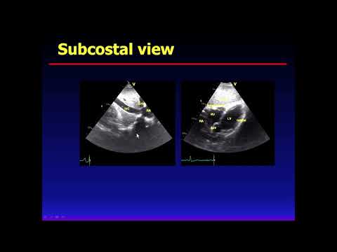 Basics in Echocardiography