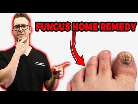 , title : '20 Ways To Get Rid of Toenail Fungus (Proven CURE & Home Remedies)'