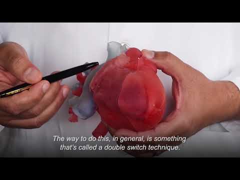How a 3-D-Printed Heart Replica Helped Plan a Double Switch Procedure
