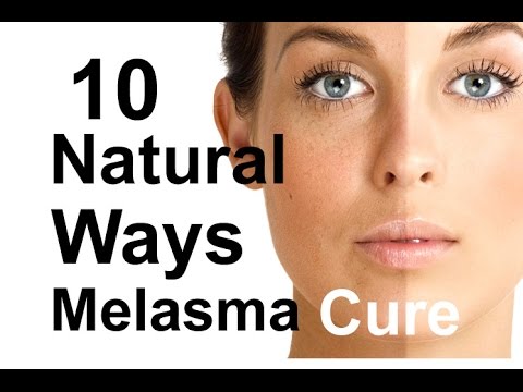 Natural Treatment For Melasma (Cure) 10 Melasma Treatments - Home Remedies