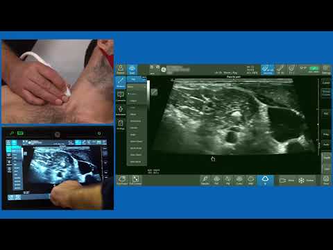Interscalene Brachial Plexus Block