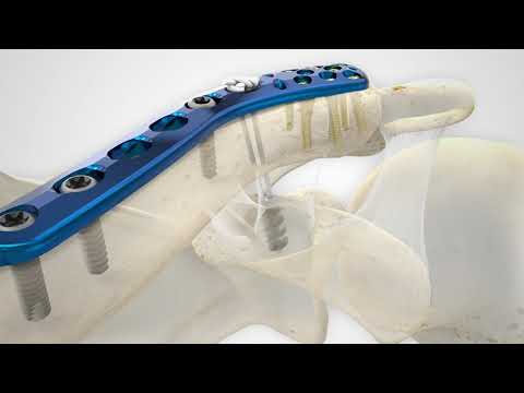 Clavicle Plating System Overview Animation