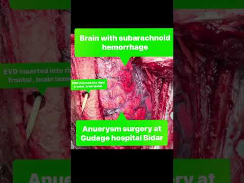 Grade 4 Subarachnoid Hemorrhage