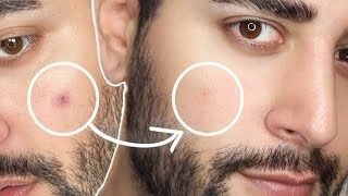 FADE DARK SPOTS FAST! 😲 Brown Spots, Discolouration And Hyperpigmentation ✖  James Welsh