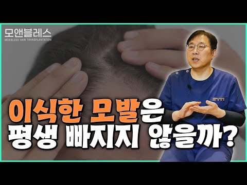 [모앤블레스의원] 모발이식 과연 영구적일까?