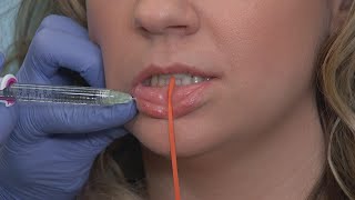 Keyhole Pout Procedure for Fuller Lips