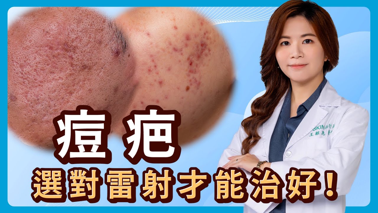 有痘疤怎麼辦? 選對雷射才能治得好! 麒惠醫師分析給你聽｜iSKIN【皮膚專科】 #痘疤#UP雷射#無限電波 #痘疤治療