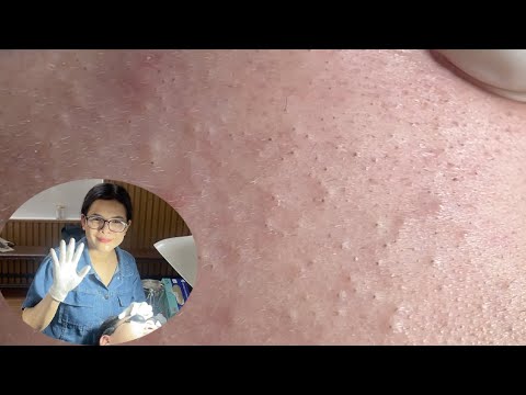 Acne Treatment Huong Da Nang#603 _ 2024 #hiddenacne