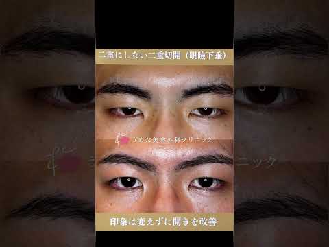 医学科 二重にしないのに二重切開？