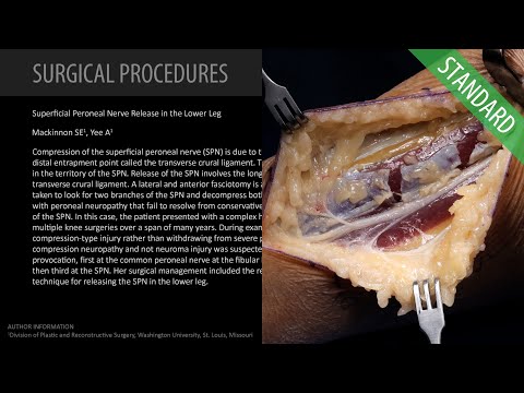Superficial Peroneal Nerve Release in the Lower Leg - Standard