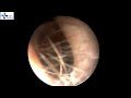 Endoscopic Repair Of Nasal Septal Perforation