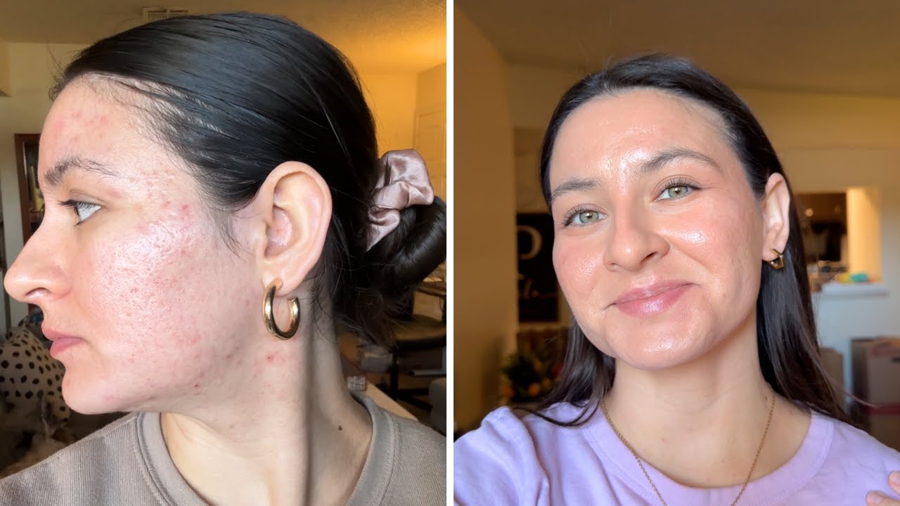 My Acne Journey & First Cool Peel Laser Treatment