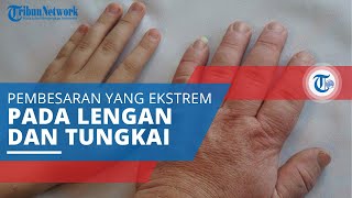 Akromegali, Pembesaran Ekstrem yang Terjadi pada Lengan dan Tungkai
