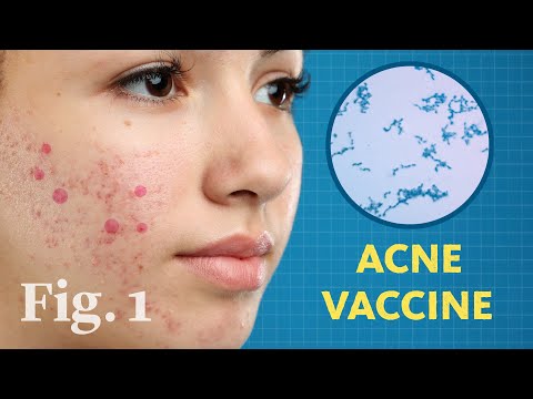 New science UNLOCKS a major cause of acne — AND a new ...