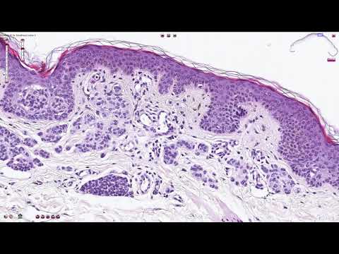 Compound Melanocytic Nevus - Histopathology