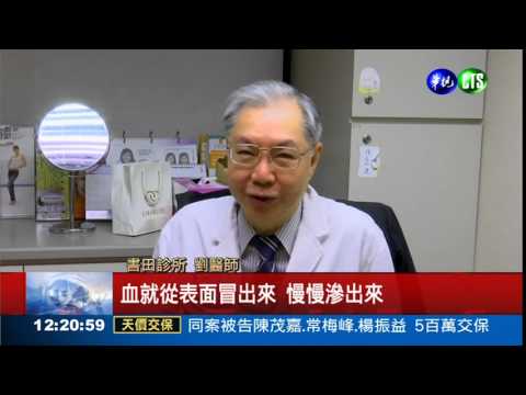 肉芽腫痘痘 男大生擠爆血!