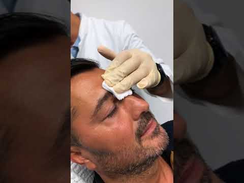 Livechat mit Dr. Akbas & Dr. Alt vom 06.08.2018 aus Düsseldorf über Falten mit Live-Unterspritzung