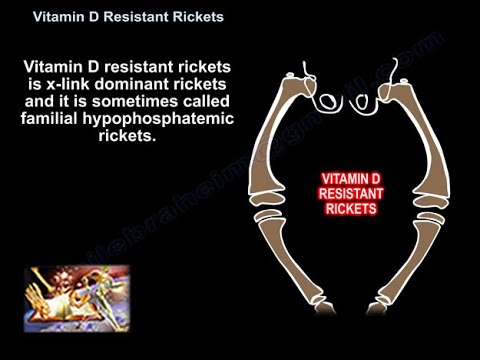 Raquitismo resistente a la vitamina D - todo lo que se debe saber