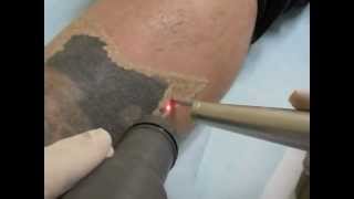 Video Eliminacion tatuajes.m4v - Clínica Dr. Herrera Saval Bonaderma