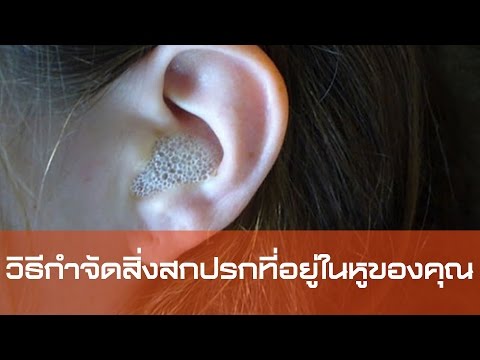 เลเซอร์ทางหลอดเลือดดำสำหรับโรคสะเก็ดเงิน กลากบนผิวหนังมนุษย์