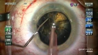 the BLACKEST cataract of them ALL! (no audio)