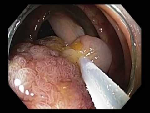 Giant Pedunculated Polyp Resection