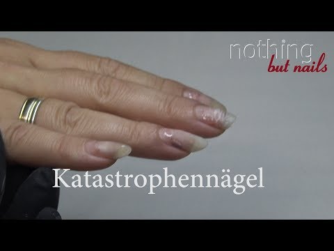 Das ergebnisreiche Medikament bei gribke der Nägel auf den Beinen Die Präparate von gribka zwischen den Fingern der Hände