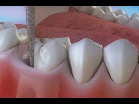 दंत क्षय उपचार (Endodontics) ©