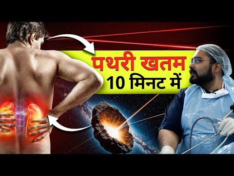 पथरी का इलाज 10 मिनट में | LASER Kidney Stone Live