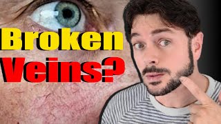 How to TREAT & PREVENT Spider (BROKEN) Veins On The Face | Can You Stop Them? | Chris Gibson